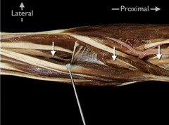 <p>In this anterior view of the right elbow and forearm, identify the nerve indicated by the arrows.</p>