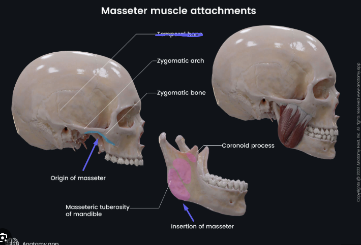 <p><strong>Origin:</strong> Zygomatic arch and bone.</p><p><strong>Insertion: </strong><u>Angle </u>and <u>Ramus </u>of mandible.</p><p><strong>Action: </strong>Closes jaw.</p><p><strong>Antagonist: </strong>Digastric muscle.</p>