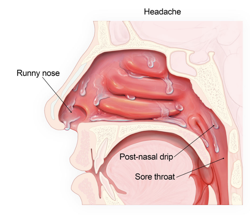 <p><span><span>generally milder, include things like tonsillitis and the common cold. </span></span></p><ul><li><p><span><span>Inflammation of the sinuses (sinusitis) and increased mucus production causes symptoms like a runny nose (coryza), headache, low-grade fever, and sneezing. </span></span></p></li><li><p><span><span>Some mucus can drip down the posterior side of the pharynx (post-nasal drip) into the larynx, contributing to symptoms like a cough and sore throat. In most cases, </span></span></p></li><li><p><span><span>URTIs are viral and will self-resolve without treatment.&nbsp;</span></span></p></li></ul><p></p>