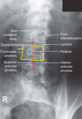 <ul><li><p>45 degree rotation indicated by 5 Scottie dogs stacked on top of each other</p></li><li><p>Open zygapophyseal joints and the pedicle between the midline and lateral aspect of the vertebral border</p></li><li><p>May be different at L1 and L5 - <strong>Evaluate the L3 pedicle</strong></p></li></ul><p></p>
