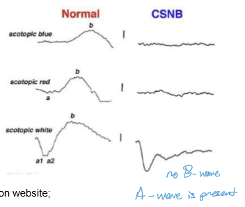 <p>CSNB involves impaired photoreceptor → bipolar cell neurotransmission.<br>→ Detected using full‑field ERG, which reveals characteristic abnormalities in the b‑wave (post‑photoreceptor response).</p>