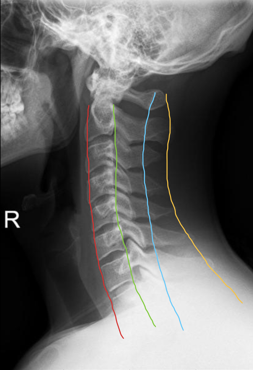 <p><span>棘突后缘线</span></p>