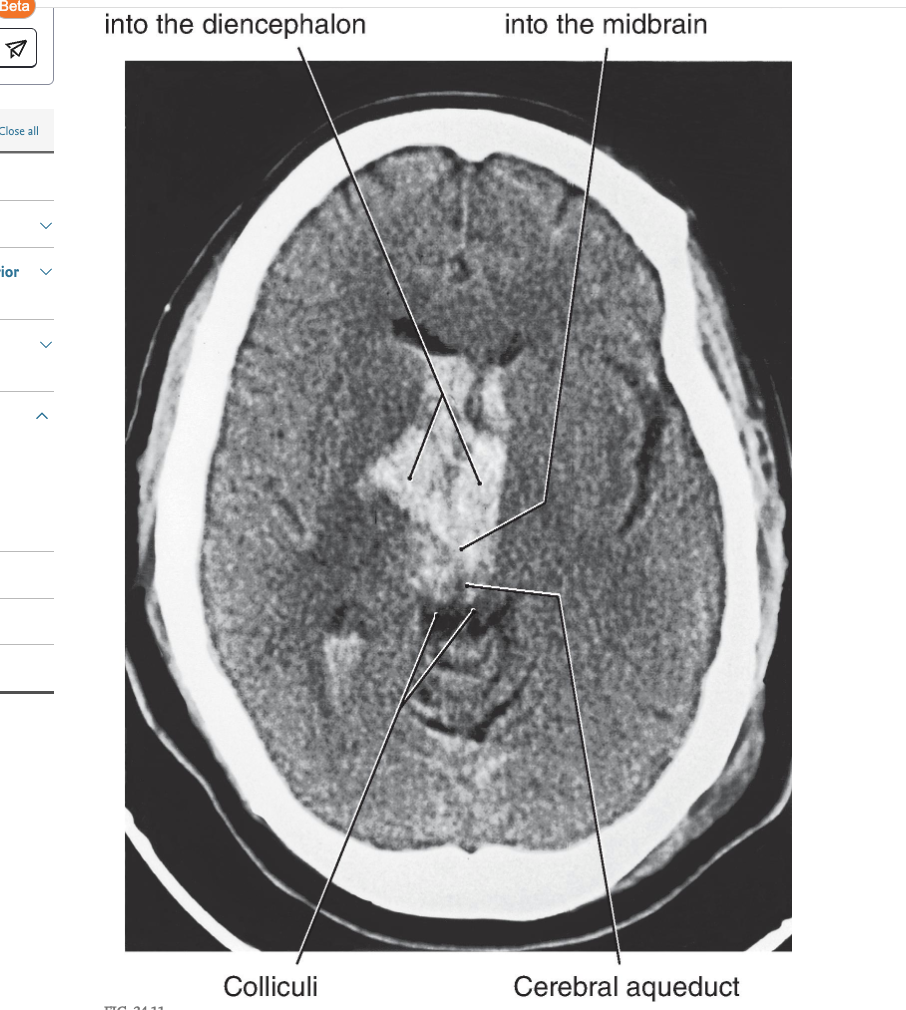 <p>Removal of the influence of the cerebral cortex and other higher centers on brainstem-spinal systems was the premise in this experiment, with the idea that whatever functions remained were controlled predominantly by the brainstem-spinal systems. In the basic experiment, under deep anesthesia, the brainstem was completely transected bilaterally between the superior and the inferior colliculi ( Figs. 24.9A and 24.10A ). This procedure resulted in a constellation of deficits that closely resemble those seen in patients with <strong>supratentorial </strong>lesions that cause herniation of the midbrain downward through the <strong>tentorial notch, a process referred to clinically as central, or transtentorial herniation </strong>( Fig. 24.11 ). The experimental lesion in animal models, like the comparable lesion in humans, results in unopposed hyperactivity in extensor musculature in all four extremities, a condition called <strong>decerebrate rigidity </strong>( Fig. 24.12 ).</p>