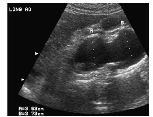 <ul><li><p>uncommon </p></li><li><p>dysplasia of the aortic wall (hour glass type) </p></li><li><p>membrane with central orifice </p></li><li><p>hypoplasia of ascending aorta </p></li></ul><p></p>