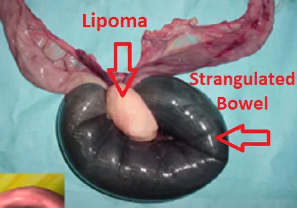 <p>Lipomas</p>