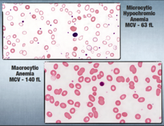 <p>Microcytic anemia and macrocytic anemia.</p>