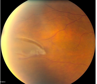 <p><em>AKA flap tear</em></p><ul><li><p>Apex attached to the vitreous</p></li><li><p>Base attached to the retina</p></li><li><p>Most common lesion leading to Rhegomatogenous retinal deatchment</p></li></ul><p></p>