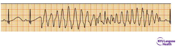 <p>Identify the above waveform:</p><p>a. unifocal PVCs</p><p>b. Trigeminy</p><p>c. Torsades</p><p>d. multifocal PVCs</p>