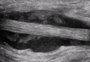 <p><span style="background-color: transparent;">Inflammation of sheath surrounding tendon → presents as fluid accumulation around tendon</span></p>
