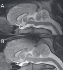 <p>Which of these is normal? What does the abnormal show?</p>