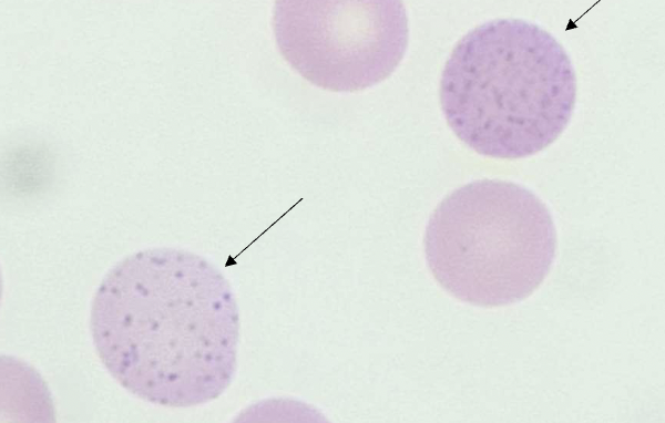 <p>name the type of RBC inclusion</p>