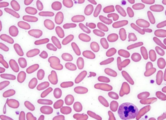 <p>abnormal cytoskeletal proteins</p><p>- cannot change back to normal shape, but still able to carry O2 like regular RBCs</p><p>- irregular, elliptically shaped RBCs</p><p>Conditions Assoc: Hereditary elliptocytosis, Iron Deficiency Anemia (IDA)</p>