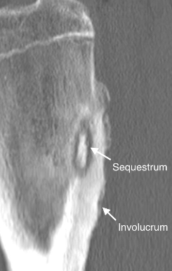 <p>a <span style="color: red;">dead bone</span> surrounded by <span style="color: red;">granulation tissues</span></p>