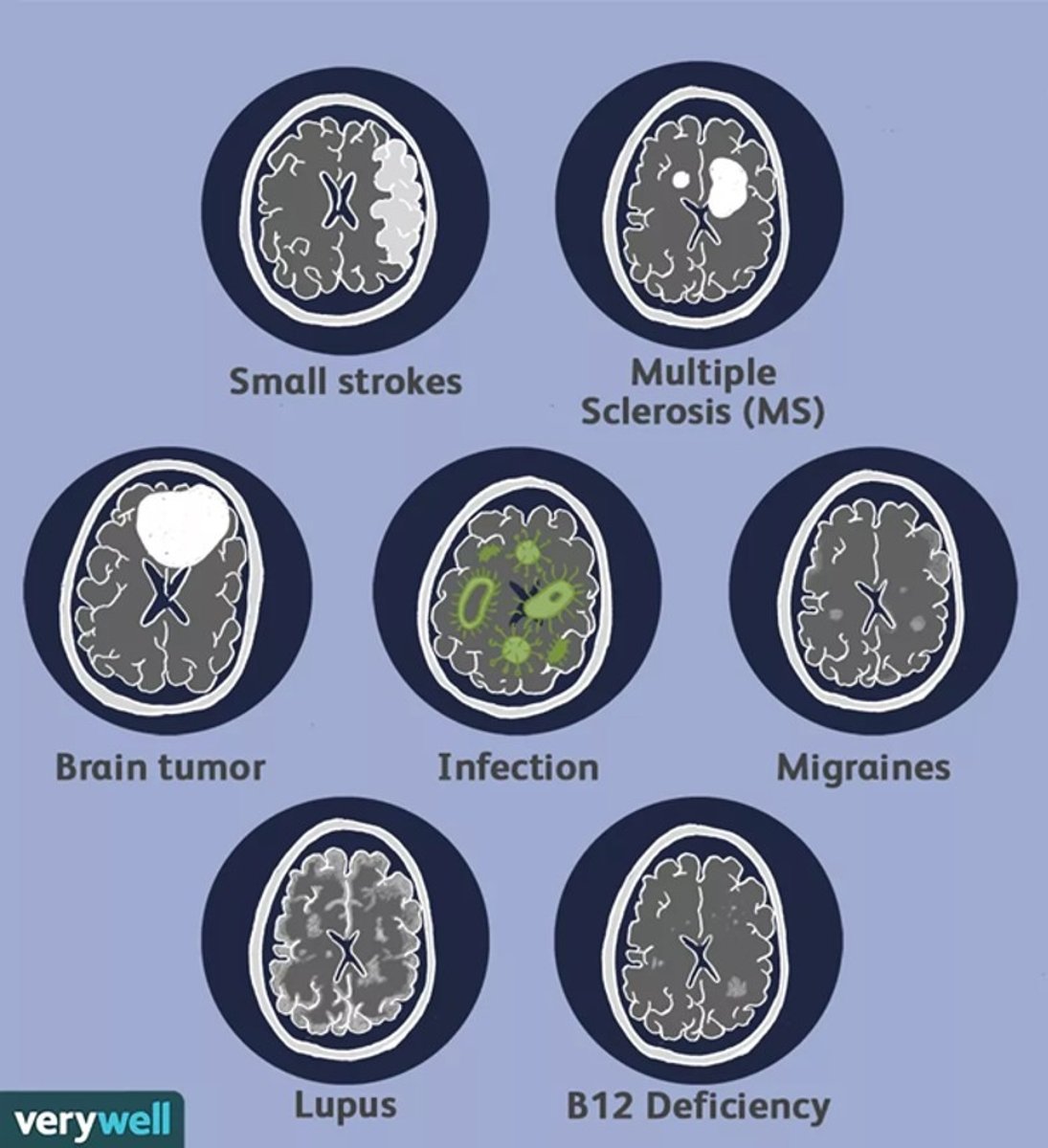 <p>•White matter hyperintensities (WMH)</p><p>•Pathologies linked to different causes</p><p>•Bright white spots are neural atrophy</p>