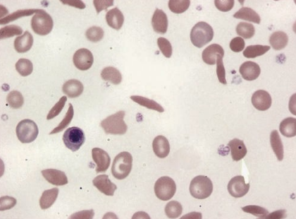 <p>what would the RBC morphology look like in those with sickle-cell anemia? <strong>(learning objective)</strong></p>