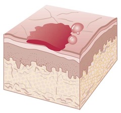 <p>Secondary lesion; a dried exudate on the skin.</p>