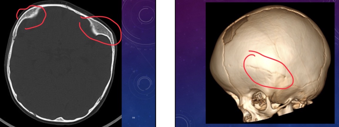 <p>15 month old female has a cranial deformity. </p>