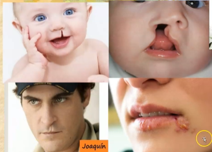 <p>Forma y volumen</p><ul><li><p>Deformaciones congenitas= Labio leporino </p></li><li><p>Adquiridas= cicatrices</p></li><li><p>Cambios de volumen= edema por reación alergica</p></li><li><p>Color= rosado/ palido (anemia)/ violáceo (cianosis)</p></li><li><p>Erupciones= en caso de haber, hay que describirlas (herpes virus 1 aparicion en inmunodeficiencias o situaciones de estres)</p></li><li><p>Comisuras simetricas/ Fisuras (rivoflavina)</p></li></ul><p></p>