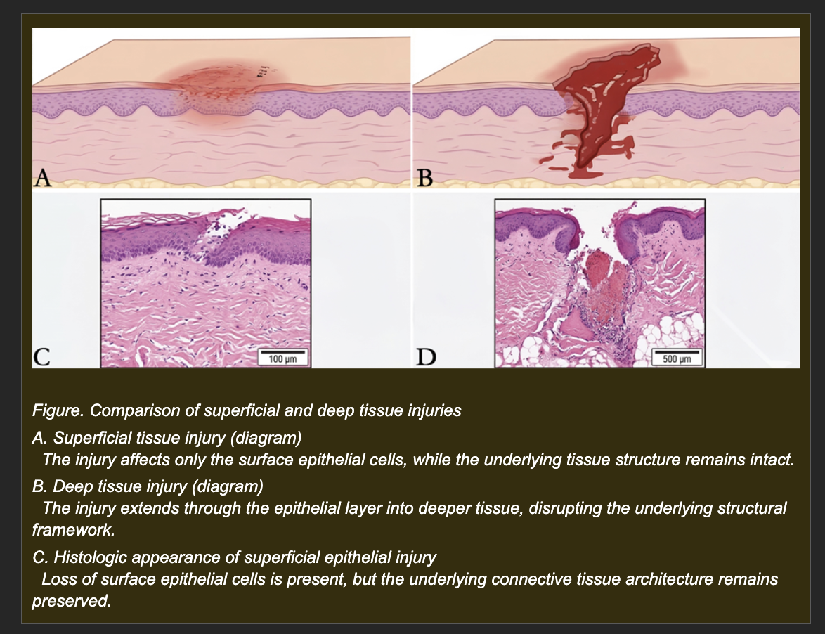 <p>A dog sustains two clean wounds on the same day, both on the skin of the trunk.</p><p>Wound A: Superficial abrasion. Only the surface epithelial cells are lost. The underlying dermal connective tissue framework -- collagen, basement membrane, fibroblasts -- is completely intact.</p><p>Wound B: Deep full-thickness laceration extending through the epidermis and through the dermis into the subcutaneous tissue. The dermal collagen scaffold and basement membrane are disrupted across the full depth of the wound.</p><p>Both wounds are clean with no infection. Both are left uncovered and monitored over 14 days.</p><p></p><p><strong>Which interpretation best explains the different healing trajectories expected for Wound A and Wound B?</strong></p><p>a. Wound A will heal more slowly because superficial injuries have less inflammation to drive repair, while Wound B will heal faster because deep injuries trigger greater proliferative responses</p><p>b. Wound A will scar because it is on the trunk where scarring is common, while Wound B will regenerate because the deeper tissue layers are more regenerative</p><p>c. Wound A will heal by regeneration because the intact dermal scaffold guides epithelial cells back to their normal position; Wound B will heal by repair with fibrotic scar because the disrupted scaffold cannot be rebuilt and fibroblasts fill the defect with collagen instead</p><p>d. Both wounds will heal identically by fibrotic repair regardless of depth because the inflammatory response triggered by any skin injury always produces scar</p>