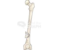 <p>What is a comminuted fracture?</p>