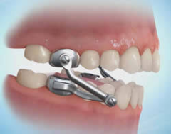 <p>what functional appliance:</p><p>◦ Rod and tube system</p><p>◦ The length of the rod forces the patient to bite forward in a more protrusive position</p>