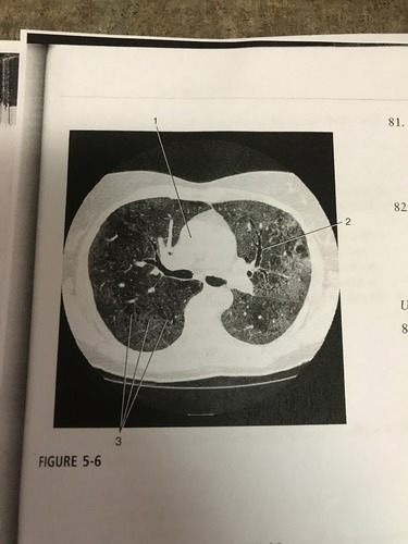 <p>This HRCT image of the chest was most likely acquired with a section width of:</p><p>A) 1mm</p><p>B) 5mm</p><p>C) 7mm</p><p>D) 10mm</p>