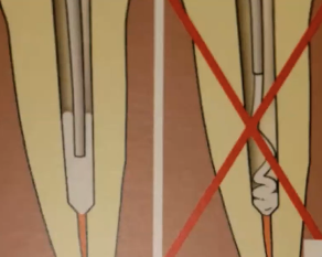 <p>T/F: It is recommended to quickly fill the canal in one motion by immersing the tip and injecting cement called “Immersion Filling”</p>