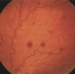 <p>Which retinal layer do dot/blot hemorrhages associated with NPDR occur?</p>