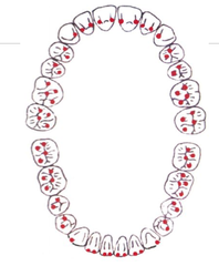 <p>Where the occlusal cusp of one tooth touches the occlusal portion of another tooth in the opposing arch.</p>