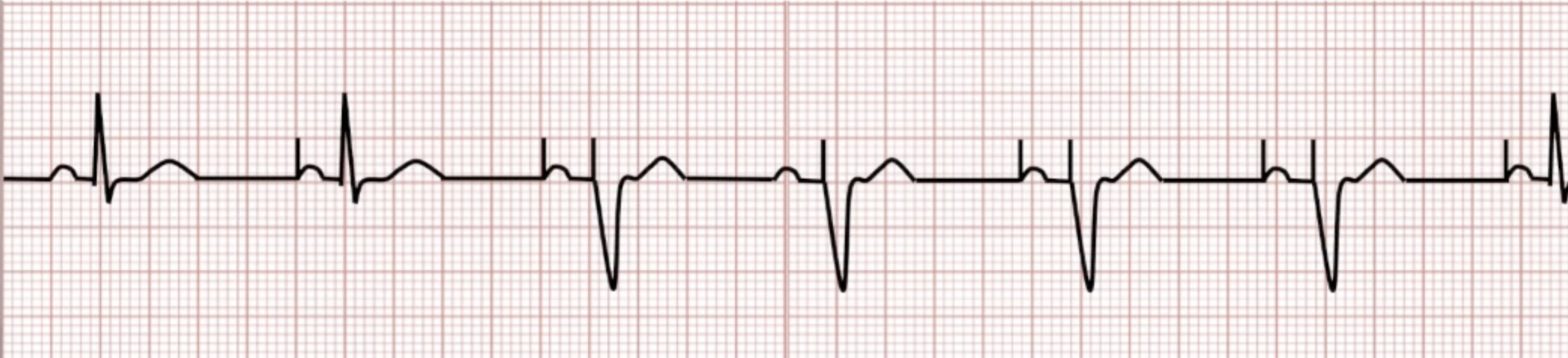 <ul><li><p>More physiologic than VVI</p></li><li><p>Leads pace each chamber separately and communicate with each other to maintain AV synchrony</p></li><li><p>Sinus rate slows: pace atrium</p></li><li><p>AV conduction slows: pace ventricles</p></li></ul><p></p>
