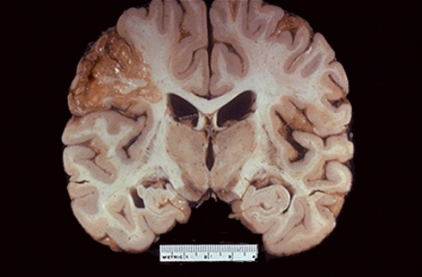 <p>Distintas formas de muerte celular generan patrones específicos en el <span style="color: rgb(0, 114, 175);">Sistema Nervioso Central (SNC)</span>. La destrucción de tejido produce necrosis, caracterizada por <strong>una digestión enzimática completa</strong>. ¿Cómo se denomina el tipo de necrosis que se observa?</p>
