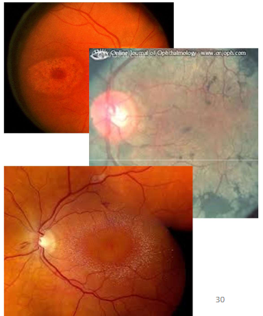 <p>Name the condition</p>