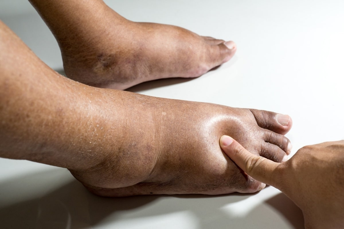 <p>Edema = ?</p>
