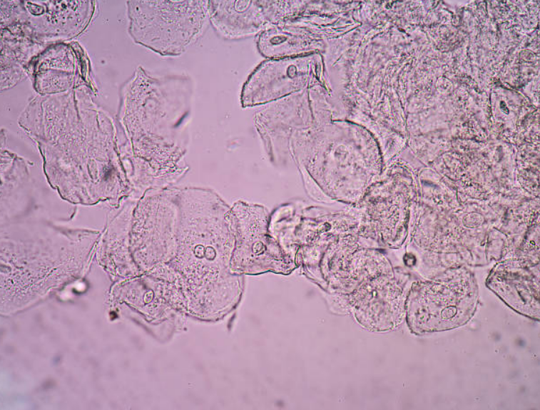 <p>Based on this microscopic field, what is the most likely explanation for this finding?</p>