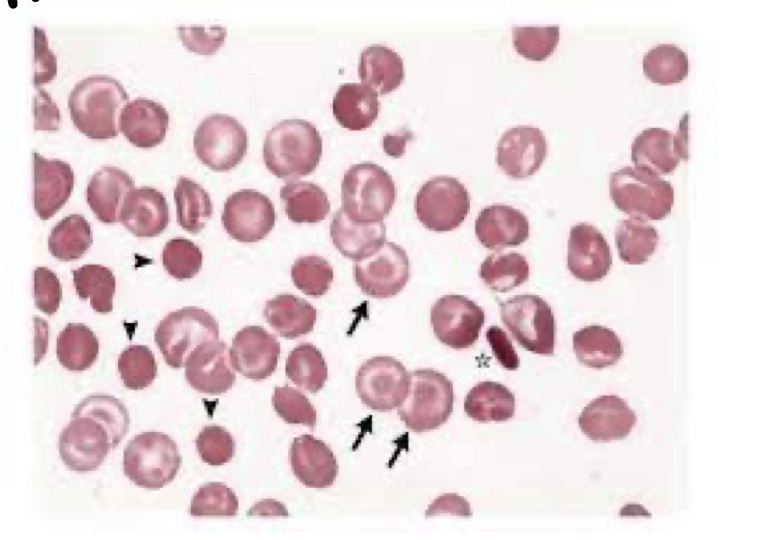 <p>What is hemoglobin C</p>