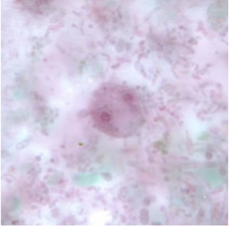 <p>-No cyst</p><p>-Trophozoite</p><ul><li><p>Round</p></li><li><p>Binucleate</p></li><li><p>Internal flagellum</p></li></ul><p></p>