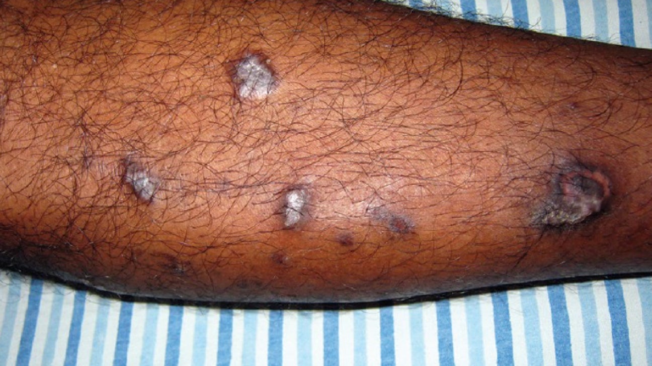 <p>Purple, flat-topped, often polygonal papules or plaques.</p>