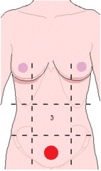 <p>inferior to the ubilical region in the abdomen</p>