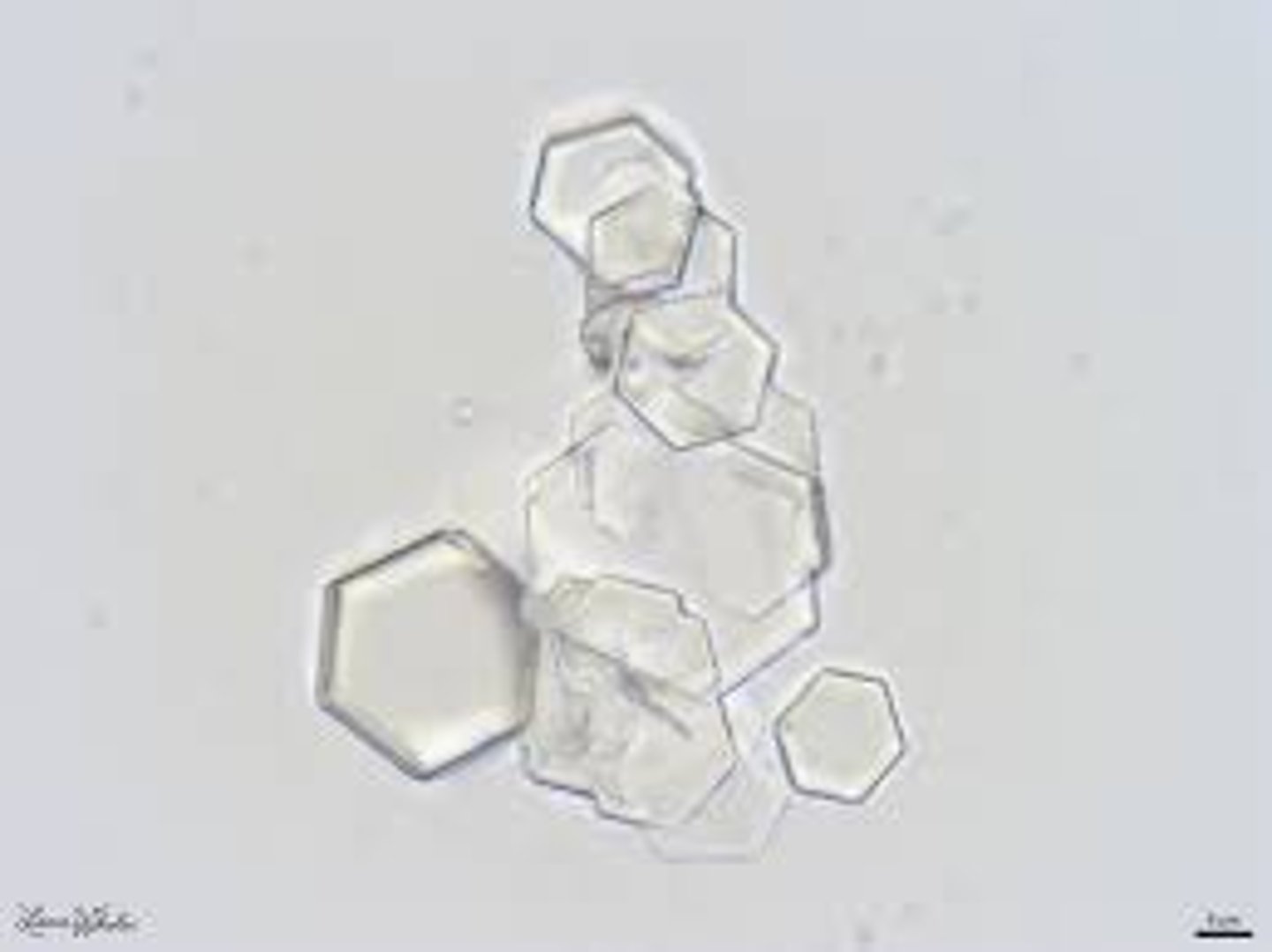 <p>Cystinuria</p>