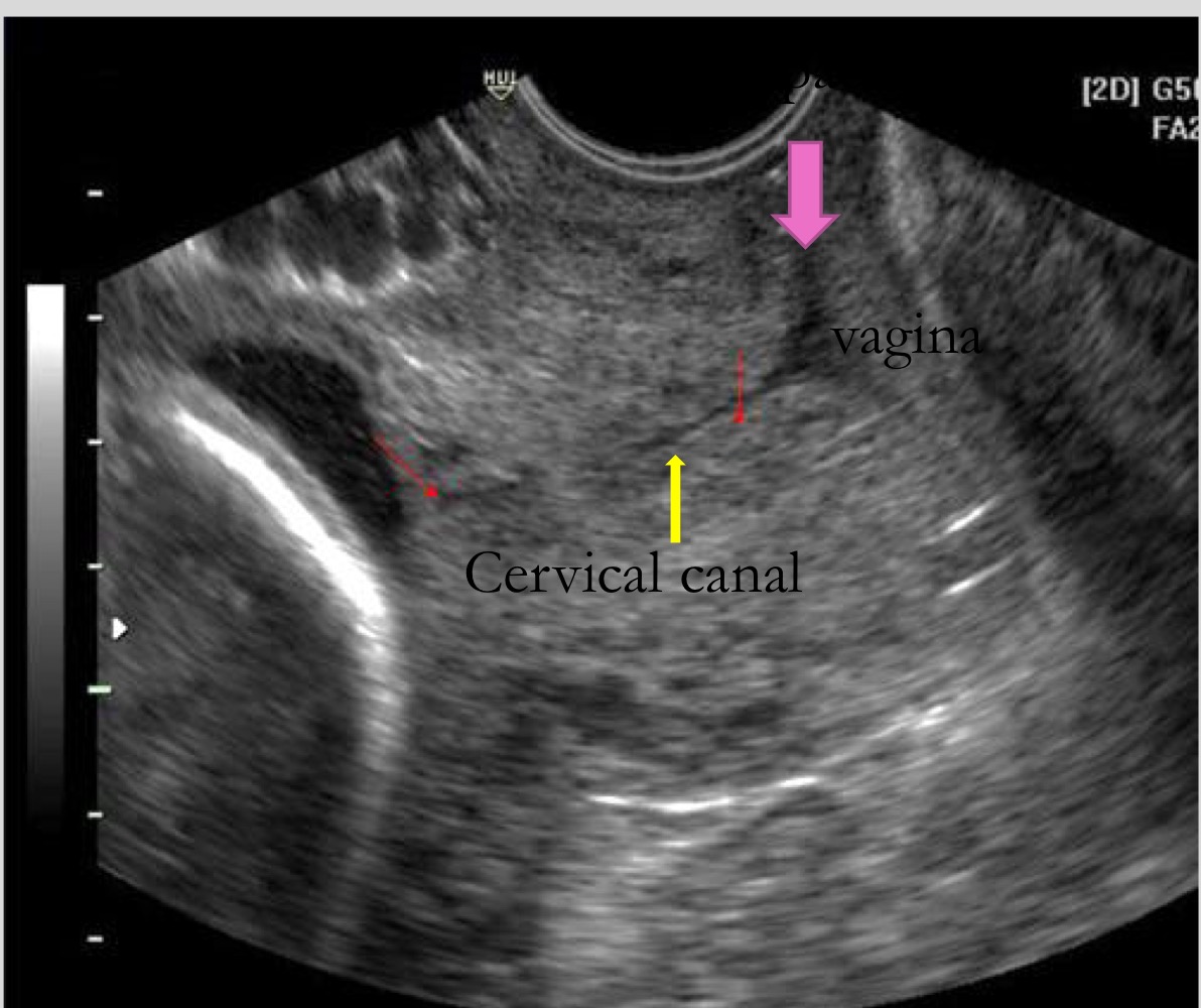 <p>Cervical canal</p>