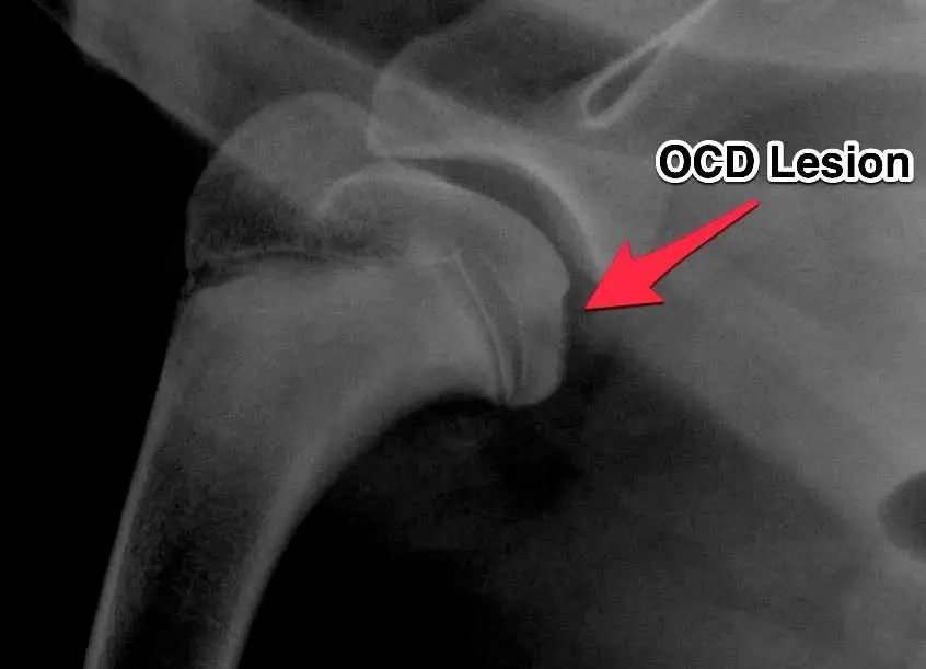 <p>Osteochondrosis dissecans (OCD)</p>