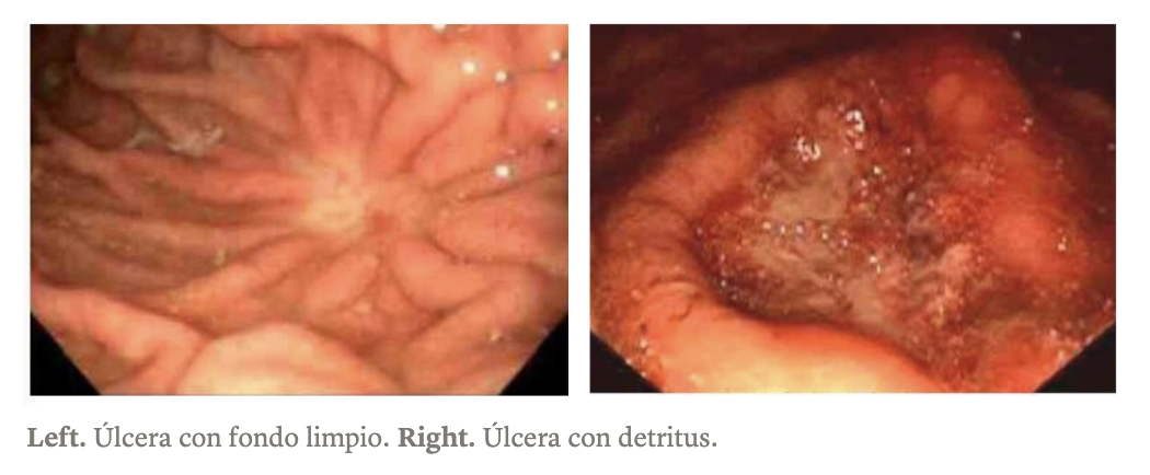 <p>ENFERMEDAD ULCEROSA PÉPTICA (ÚLCERA CRÓNICA) </p>