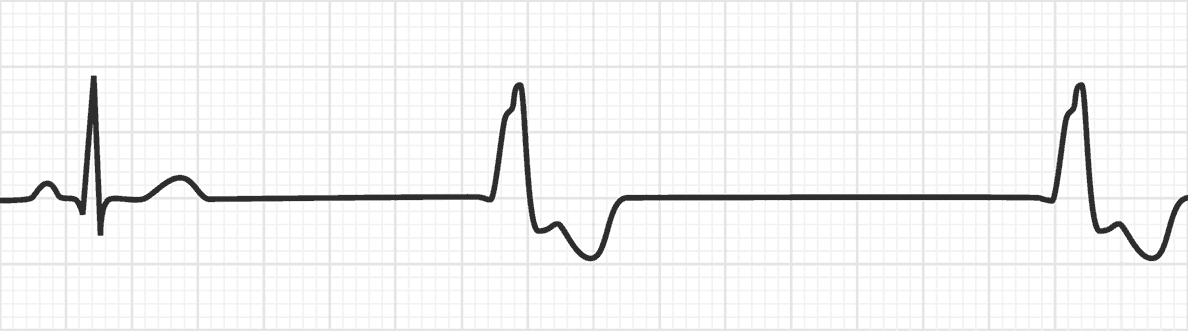 <p>Rate: depends on underlying rhythm</p><p>Regularity: irregular </p>