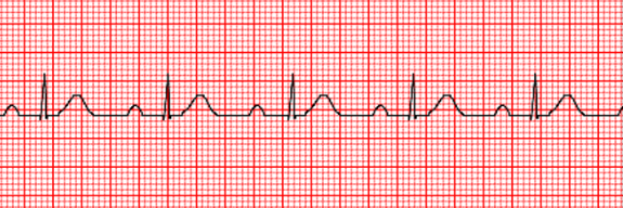 <p>PR interval long; signal ultimately reaches the ventricals</p>