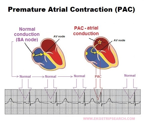 <p>management of premature atrial beats </p>