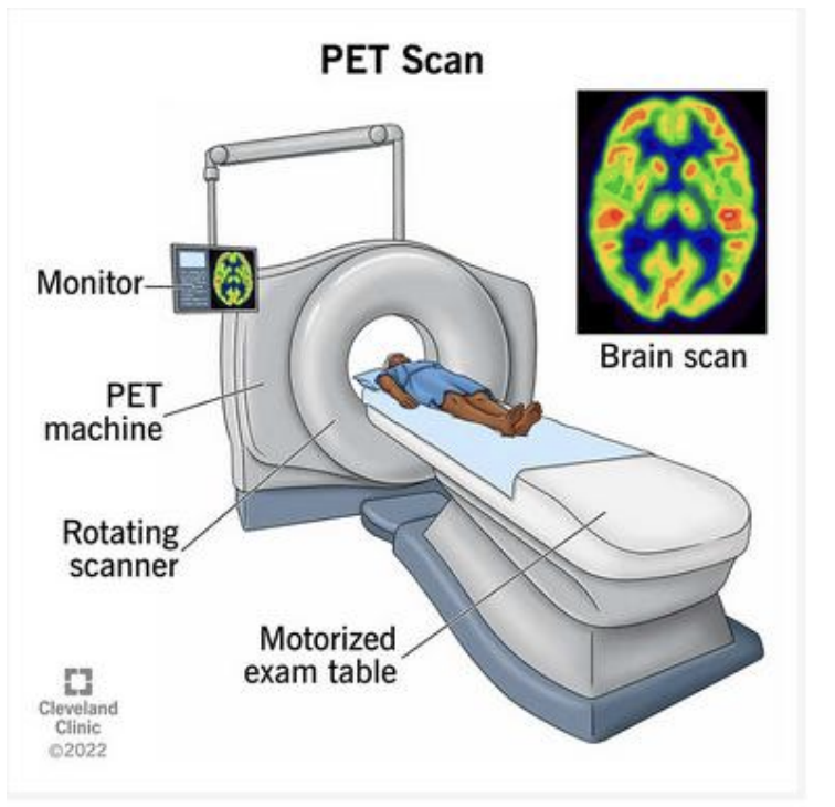 <p>-A use for positrons (anti-electrons, e+) : Positron emission tomography (PET)</p><p>-injected w/ short half-life radioactive material and edmits positrons → positrons hit electrons and send out photons (in opposite directions) → detector detects photons and their energy</p><p>-particle + anti-particle = annihilate (and edmit photons can detect; e- + e- → 2 photons)</p>