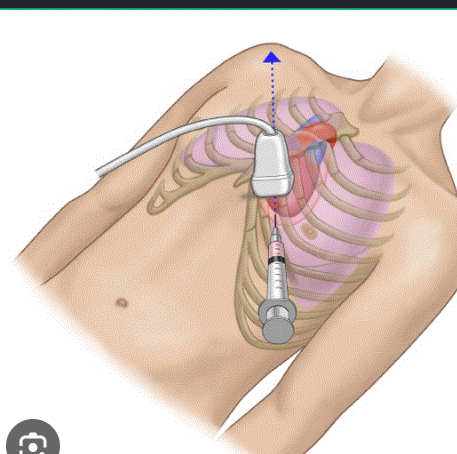 <p>The <strong>subxiphoid approach</strong>.</p>