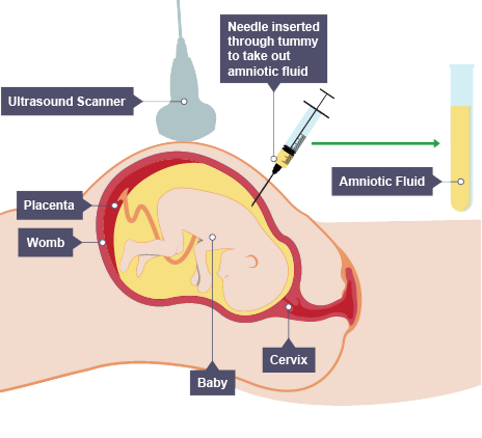 <ul><li><p>needle inserted into amniotic fluid surrounding foetus</p></li><li><p>fluid is withdrawn</p></li><li><p>foetal cells are examined for genetic conditions</p></li></ul><p></p>