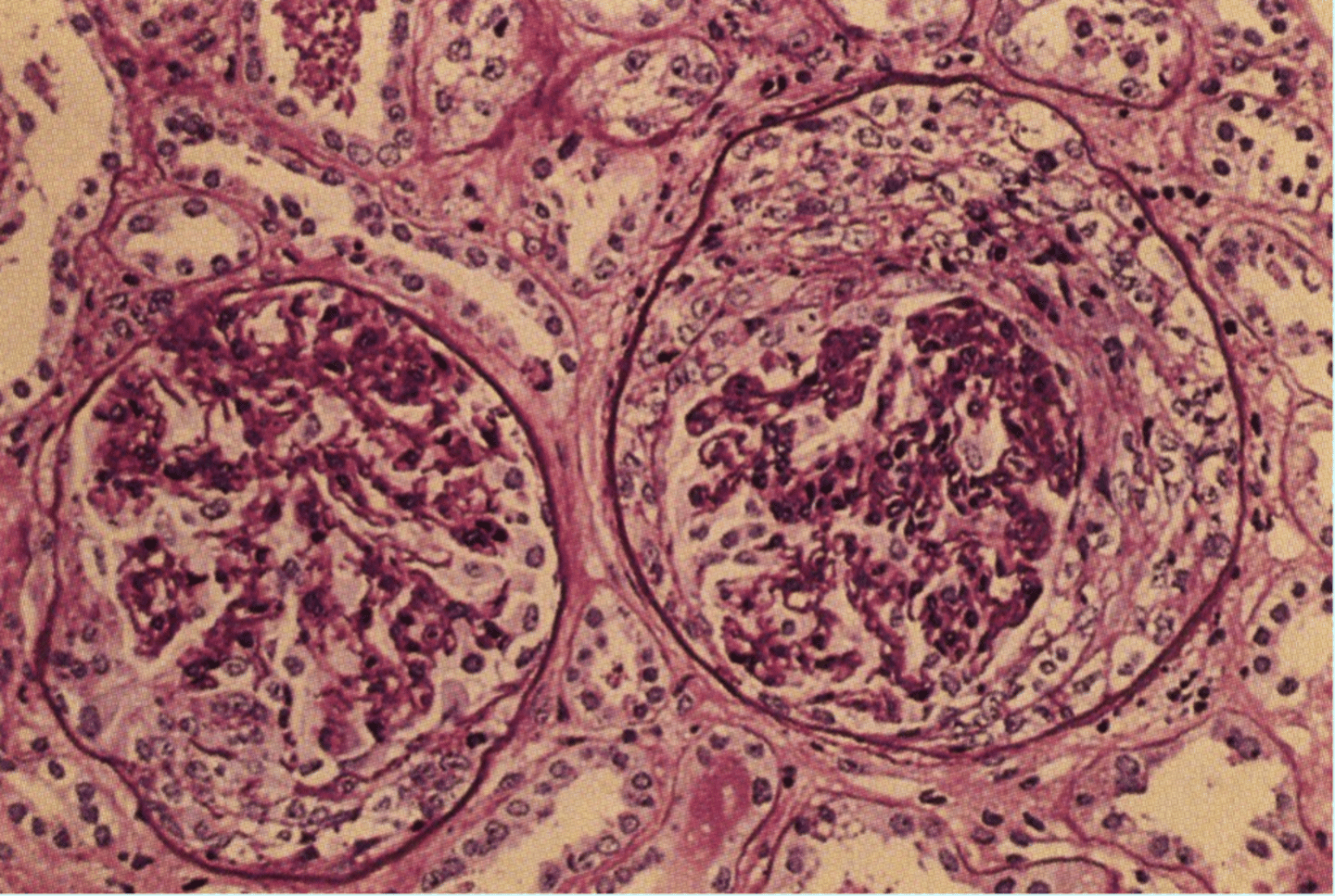 <p>Rapidly Progressive Glomerulonephritis</p>
