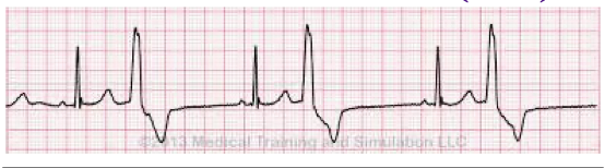 <p>Identify the above waveform:</p><p>a. Paired PVCs</p><p>b. Trigeminy</p><p>c. Bigeminy</p><p>d. PAC (premature atrial contraction)</p>